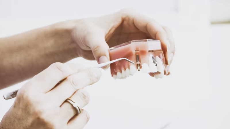 Cómo cuidar los implantes dentales